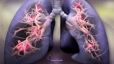 پیشگیری از سرطان ریه با ترک سیگار، اجتناب از آلودگی هوا و مواد شیمیایی سرطان‌زا، و رعایت رژیم غذایی غنی از آنتی‌اکسیدان‌ها امکان‌پذیر است. تمرینات بدنی و مراقبت از سلامت عمومی نیز به کاهش خطر کمک می‌کند.