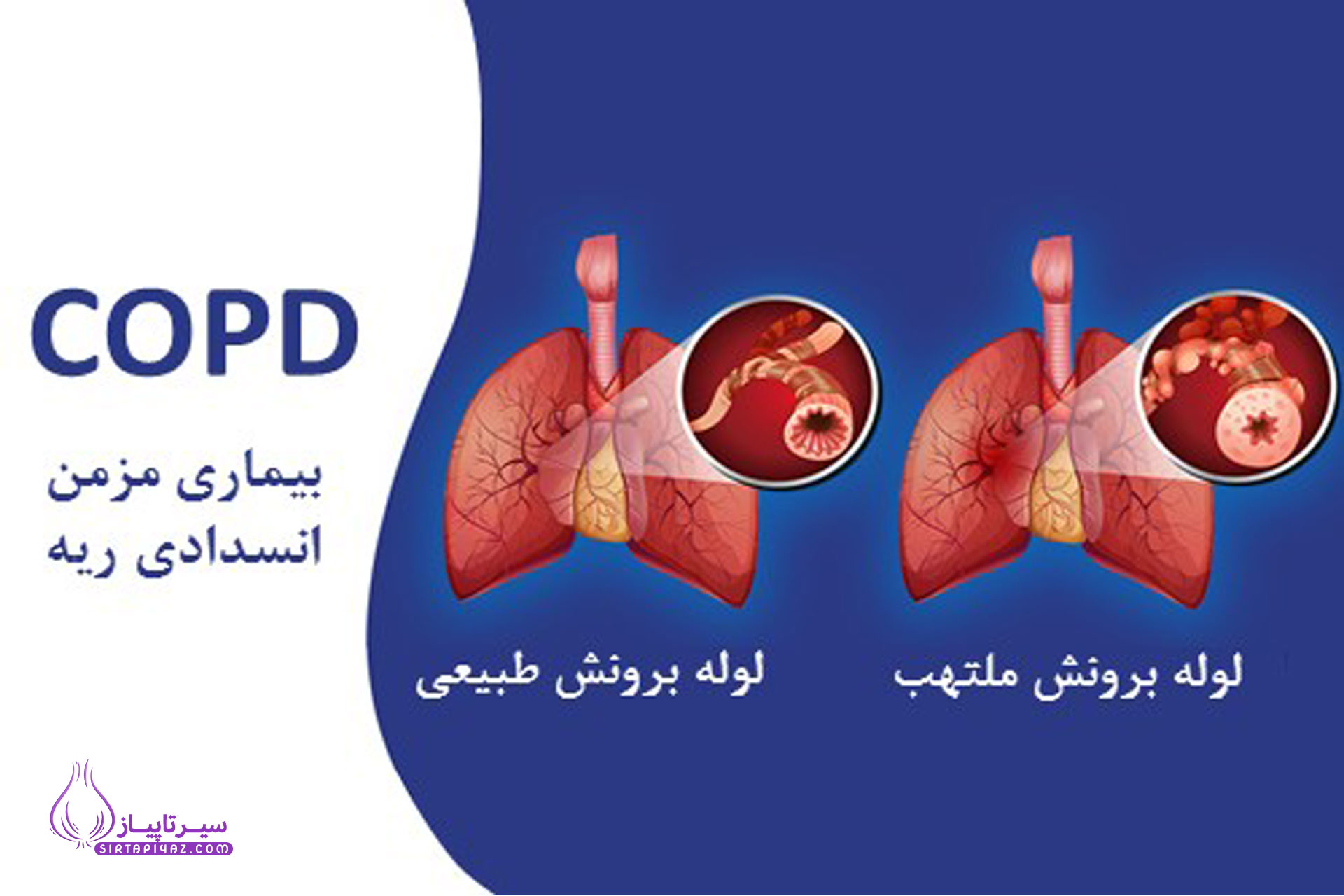 راه‌های پیشگیری از بیماری‌های مزمن ریوی (COPD)