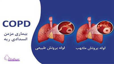 بیماری‌های مزمن ریوی (COPD) مانند برونشیت مزمن و آمفیزم، به‌طور عمده در اثر سیگار کشیدن و آلودگی هوا ایجاد می‌شوند و پیشگیری از آن‌ها شامل ترک سیگار، کاهش قرار گرفتن در معرض آلودگی و ورزش منظم است. این اقدامات می‌توانند عملکرد ریه‌ها را بهبود بخشند و خطر ابتلا به COPD را کاهش دهند.







