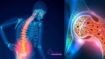 پوکی استخوان (Osteoporosis) یک بیماری است که باعث ضعیف شدن استخوان‌ها و افزایش خطر شکستگی می‌شود. پیشگیری از آن شامل مصرف کافی کلسیم و ویتامین D، ورزش‌های مقاومتی و اجتناب از سیگار و الکل است.